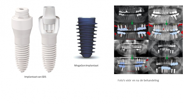 Implantaten Bij Topclass Mondzorg Apeldoorn